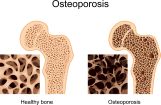 Gejala osteoporosis